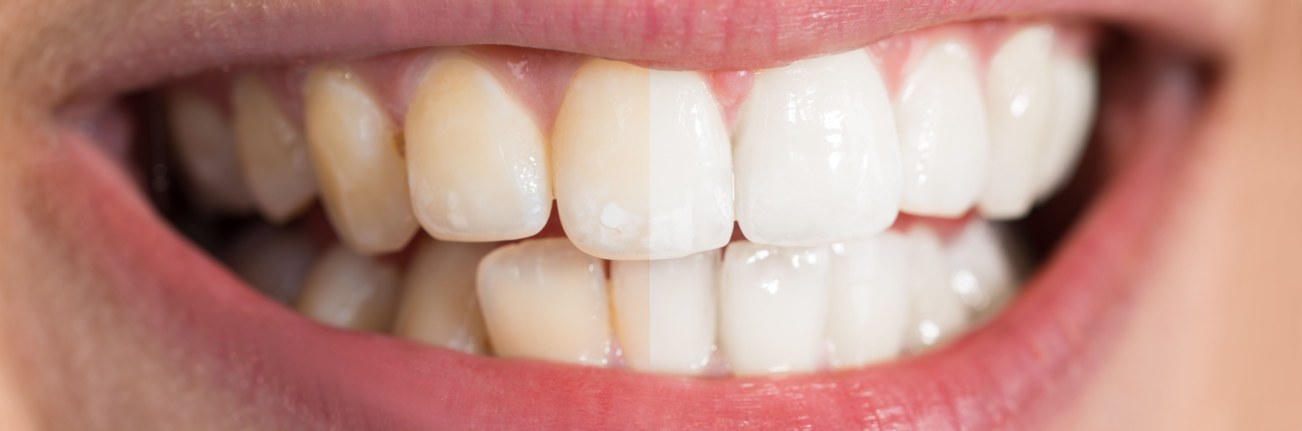 Teeth Whitening - South San Francisco Dentist